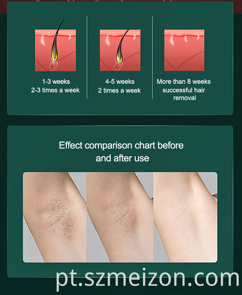 ice laser hair removal cost